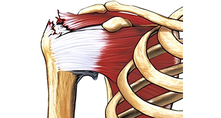 Rotator Cuff tears - Atlantic Physical Therapy