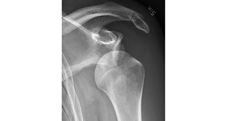 Shoulder Instability & dislocation - Atlantic Physical Therapy