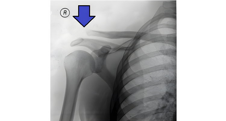 AC Joint & arthritis - Atlantic Physical Therapy