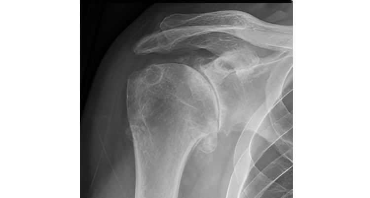 Shoulder Osteoarthritis - Atlantic Physical Therapy