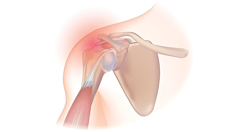 Rotator Cuff Related Shoulder Pain - Atlantic Physical Therapy